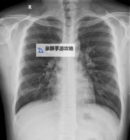 【最新】免费胸片曝光2025年已更新，全面解读未来医疗影像趋势图1